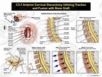 Female C3-7 Anterior Cervical Discectomy Utilizing Traction and Fusion ...