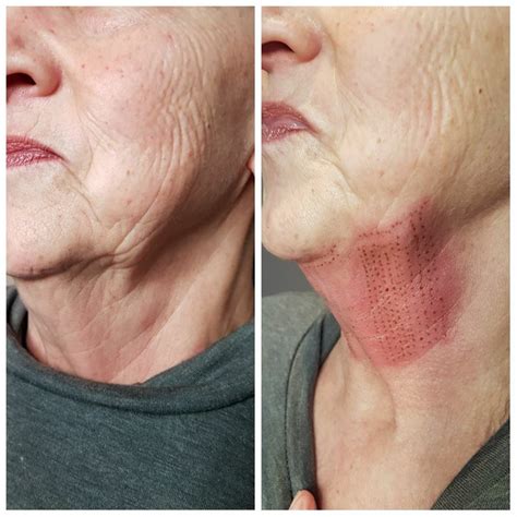 Non Surgical Neck Lift For Saggy Droppy Neck And Throatalternatives In