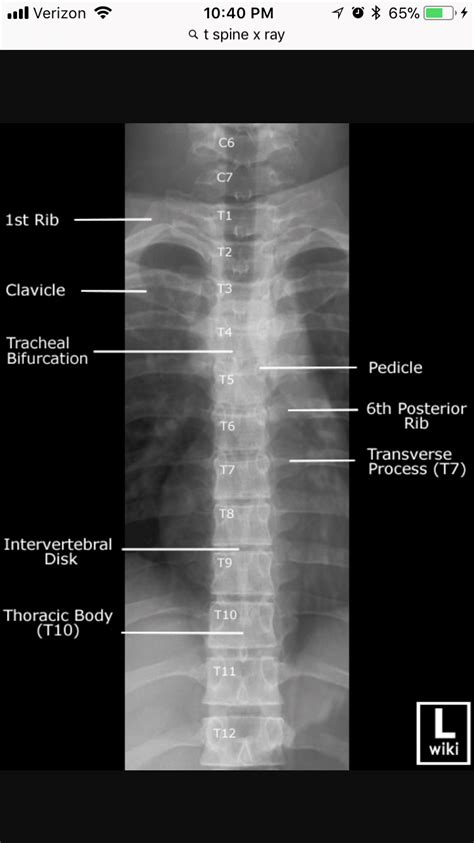 Ap Thoracic Spine Xray Radiology Student Radiology Imaging Radiology