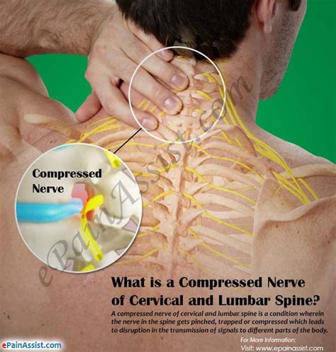 What Is A Compressed Nerve Of Cervical And Lumbar Spine Cervical