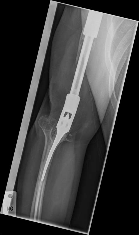 X Ray Of A Metal Arm Others