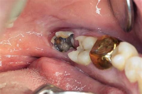When to call the dentist. How Long For Wisdom Teeth Holes To Close - A Pictures Of ...