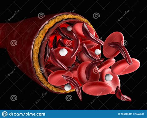 The Difference Of Normal Red Blood Cell And Sickle Cell 3d