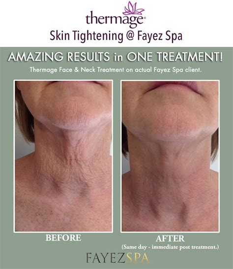 Thermage® Skin Tightening