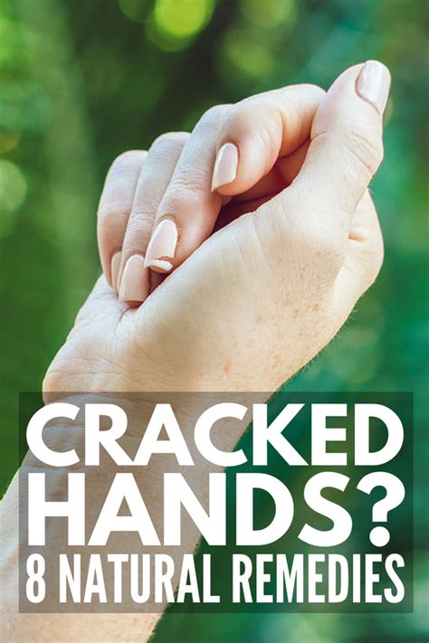 Severely Cracked Hands 8 Tips And Remedies For Fast Relief Cracked