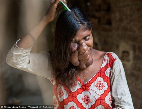 Reclusive Teen With Giant Facial Tumours Has No Friends Daily Mail Online