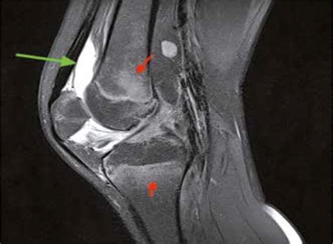 Magnetic Resonance Imaging Of The Knee Joint In Juvenile Idiopathic
