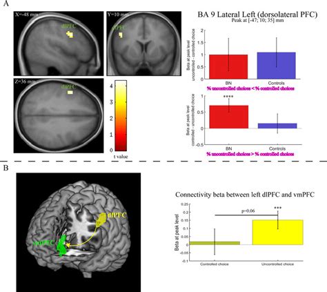 A Difference In Activity In The Left Dorsolateral Prefrontal Cortex