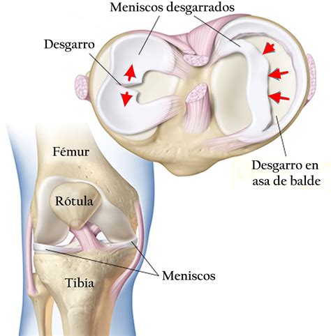 If you require meniscus repair surgery in beverly hills. Lesiones de los meniscos de las rodillas: cómo detectarlas ...