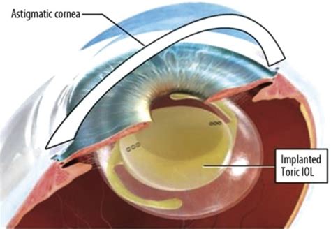 Toric Intraocular Lens Implantation Source Open I