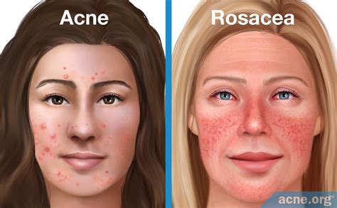 Illustration Five Signs Rosacea Redness Skin Papules Pustules Visible
