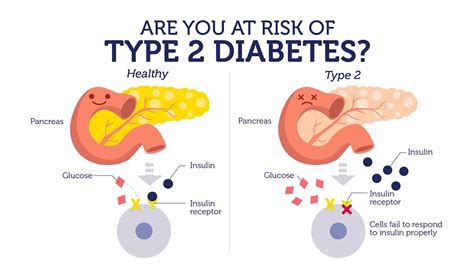 Diabetes mellitus type 2 can occur with different severity options: The rising epidemic of Type 2 diabetes in children and ...