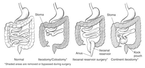 Normal Bowel And Three Types Of Bowel Diversion Surgeries Including