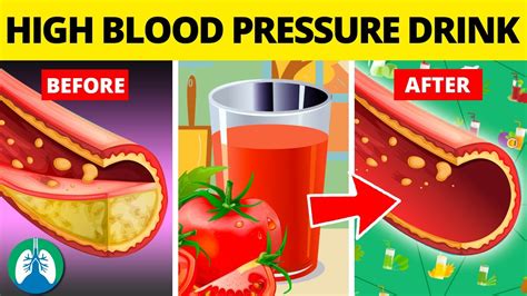 Top Drinks To Lower High Blood Pressure Naturally Youtube