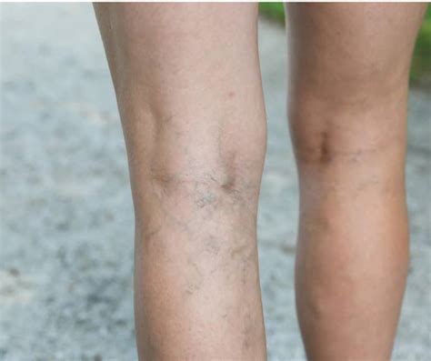 Varicose Veins Prevention Causes Symptoms Risk Factors And Preventing