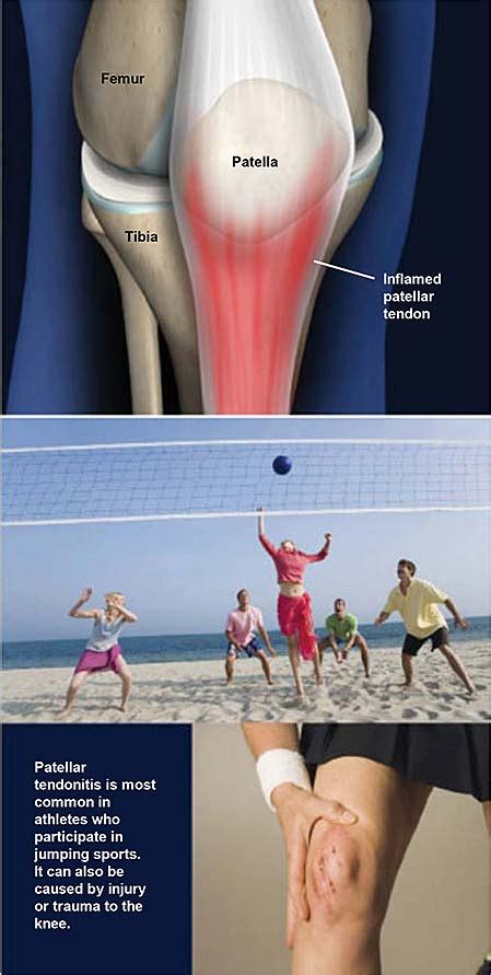 Patellar Tendonitis Jumpers Knee Central Coast Orthopedic Medical