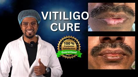 Vitiligo Treatment On Lips No Surgery No Tablets Machu Clinic
