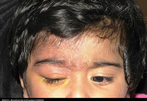 Herpes Zoster Ophthalmicus In A 1 Year Old Child Bmj Case Reports