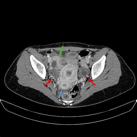 Fitz Hugh Curtis Syndrome Pacs