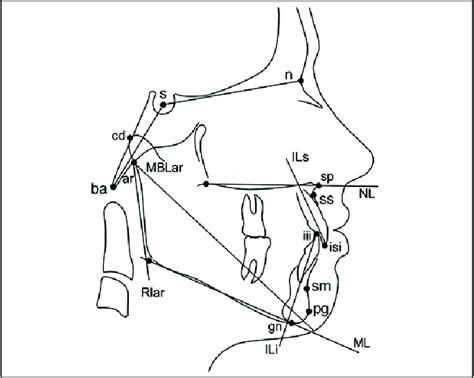 Cephalometric Landmarks Used For Measurements 14 N Nasion S Sella