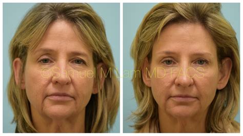 This 56 Year Old Woman Had Fillers And Botox For The First Time And Is