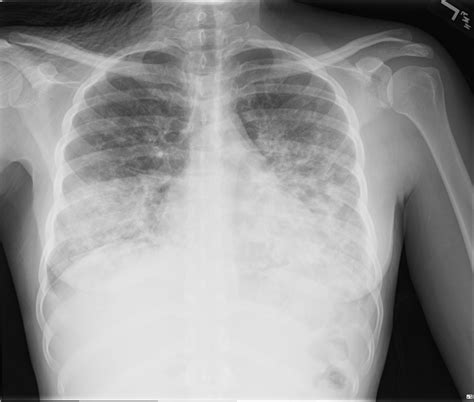 Radiographs Of Patient A Chest X Ray Cxr At Presentation Shows SexiezPix Web Porn