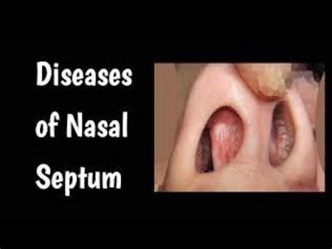 Diseases Of Nasal Septum Part Septal Hematoma Septal Abscess And Septal Perforation Youtube