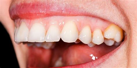 What The Color Size Shape And Feel Of Your Gums Say About Your