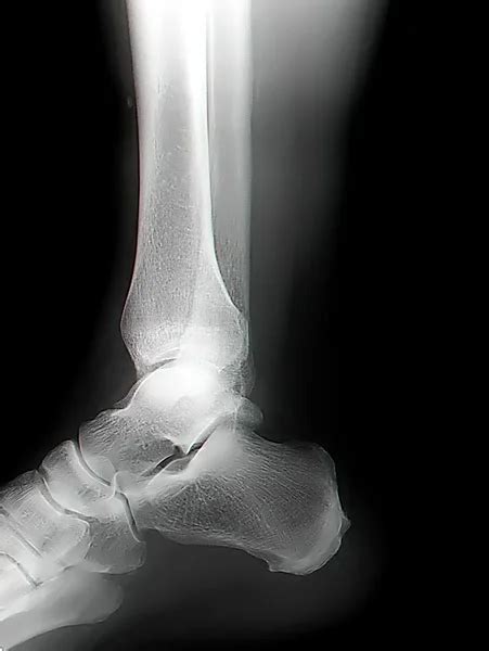 Human Leg Bone X Rays Stock Photo By ©flik47 25366583