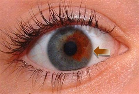What The Eyes Tell You Abnormalities Of The Iris
