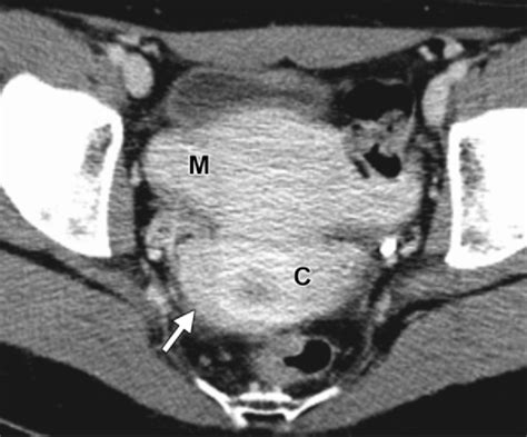 figure 16 from normal or abnormal demystifying uterine and cervical contrast enhancement at