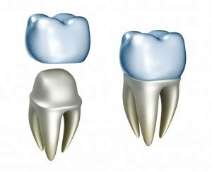 While the cost of a dental crown will vary greatly from provider to provider, those in need of a crown placement because crowns are usually not purely cosmetic and help improve the function of a tooth, insurance plans typically cover some or all of dental crown costs. Guide to Dental Crown Costs | With/Without Insurance, Implants, Gold Crowns