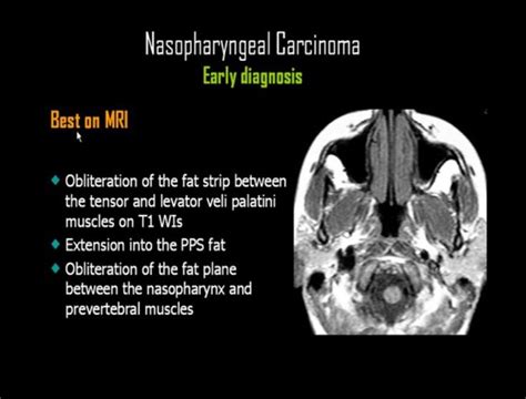 Early Diagnosis Of Nasopharyngeal Carcinoma In Mri Mri Radiology