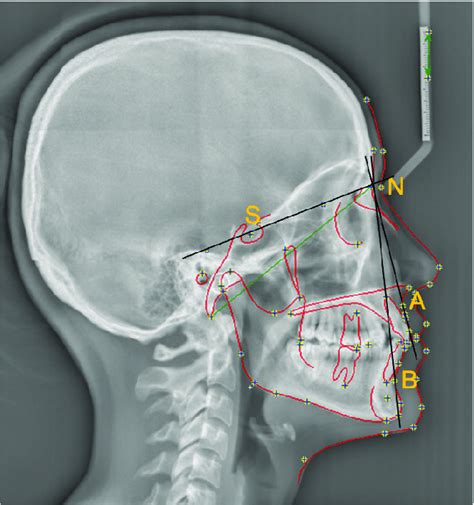 Measurement Of Anb Angle On Lateral Cephalogram Download Scientific Diagram