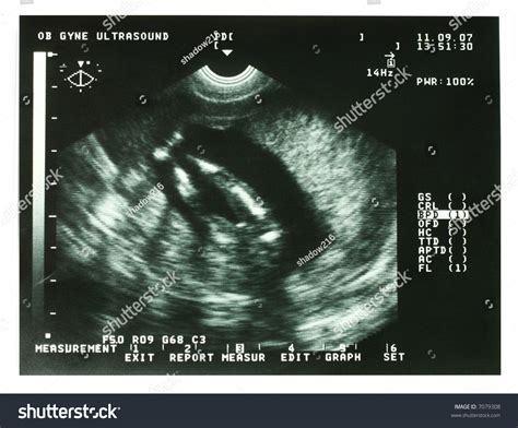 Ultrasound Image Of A Three Month Old Fetus In The Womb Stock Photo