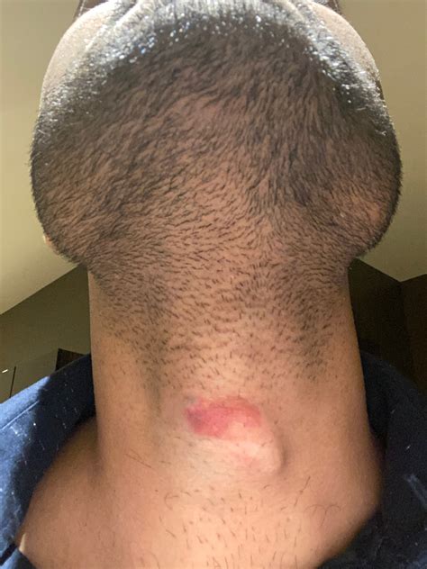 Movable Lump On Back Of Childs Head Get More Anythinks