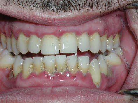 Blog Periodical Dental Disease