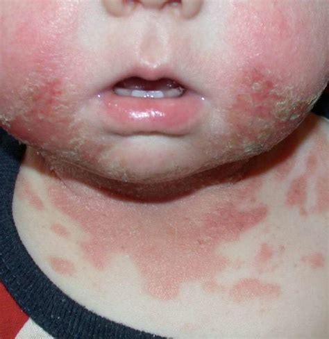 Baby Rash Causes And When To See A Doctor Kulturaupice