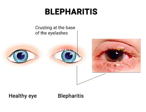Blepharitis Treatments In Nyc Best Ophthalmologists In New York
