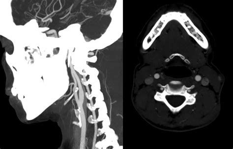Cureus Vertebral Artery Dissection And Cord Infarction An Uncommon Cause Of Brown S Quard