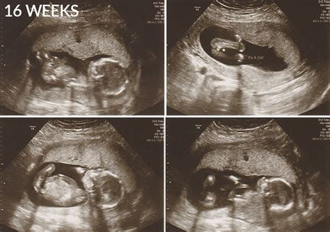 Mum And Babies 16 Weeks Pregnant Ultrasound