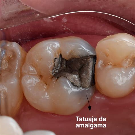 Reemplazo De Amalgamas Dentales Por Resina ¿por Qué Debo Hacerlo Dr
