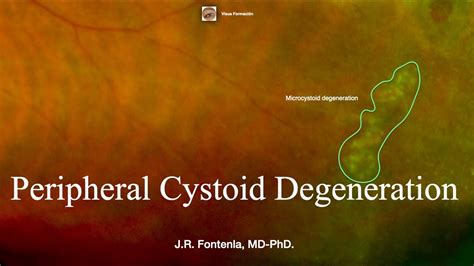 Peripheral Cystoid Degeneration Peripheral Retinal Degenerations