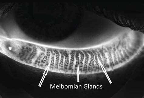 Meibomian Gland Disease
