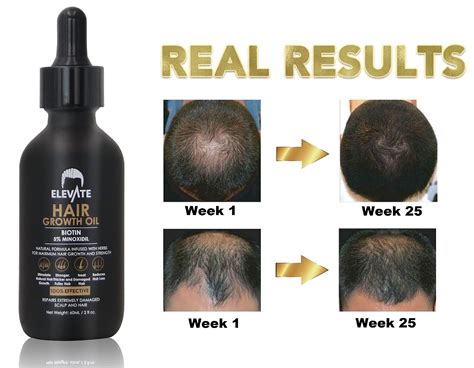 Elevate Hair Growth Oil Biotin Hair Growth Serum And 5 Minoxidil
