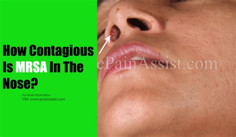 How Contagious Is Mrsa In The Nose