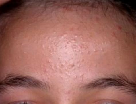 Bumps On Forehead Not Pimples Under Skin Tiny Large Lumps Zits