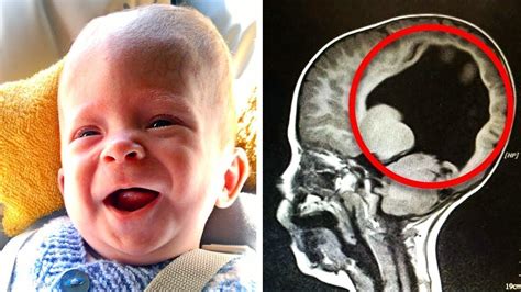 Child Was Born Without A Brain After 3 Years The Doctor Conducts An