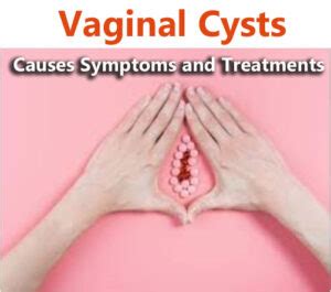 Vaginal Cysts Causes Symptoms And Treatments Healthfitns
