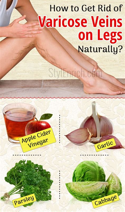 How To Get Rid Of Varicose Veins On Legs With Natural Treatment